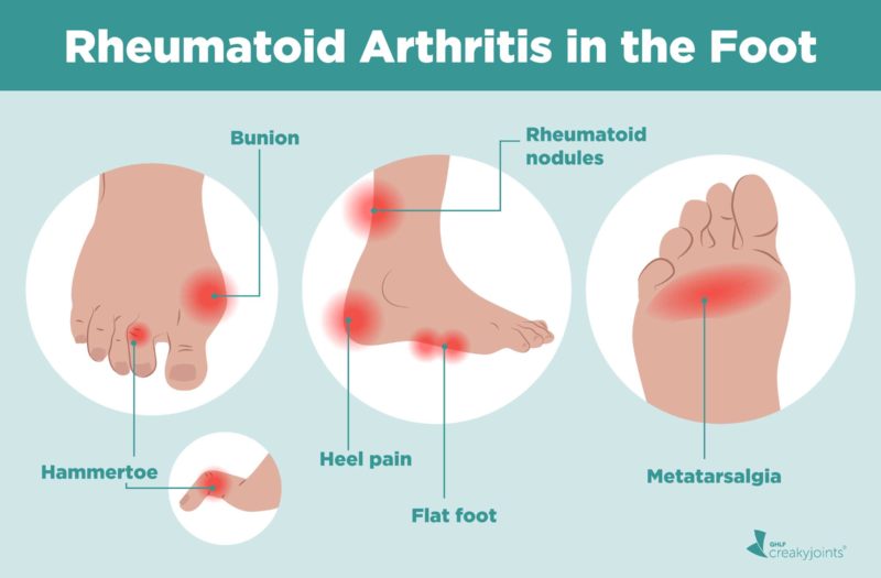 Rheumatoid Arthritis in the Feet Symptoms and Treatments