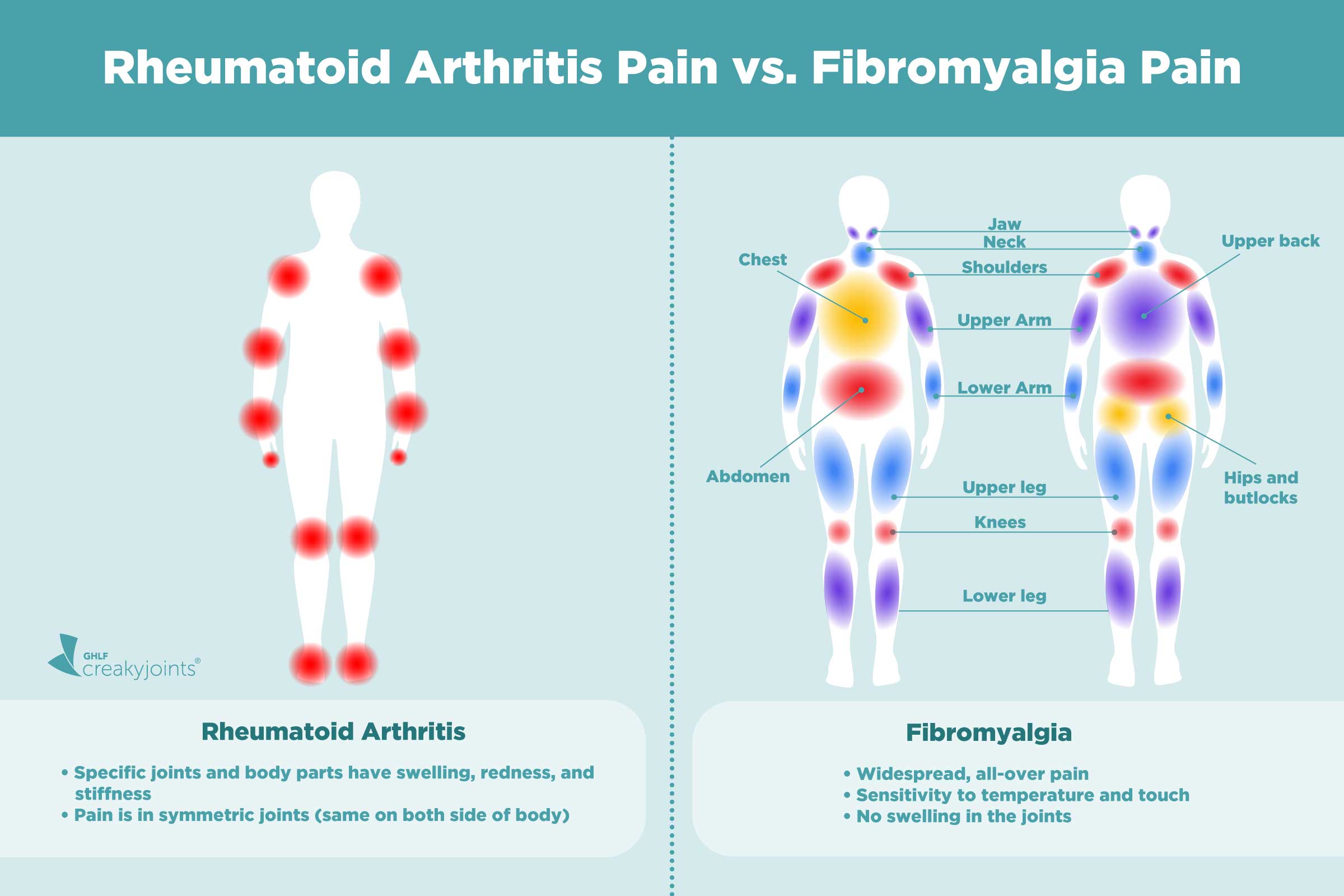 Artritis reumatoide y fibromialgia