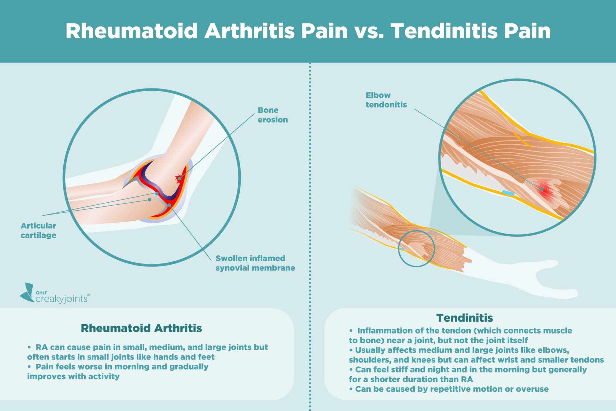 causes-of-rheumatoid-arthritis-pain-aside-from-inflammation