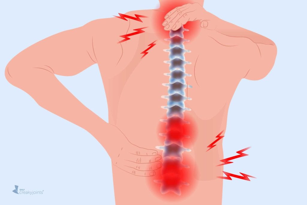 Arthritis in the Back: Symptoms, Types of Back Arthritis, Treatment