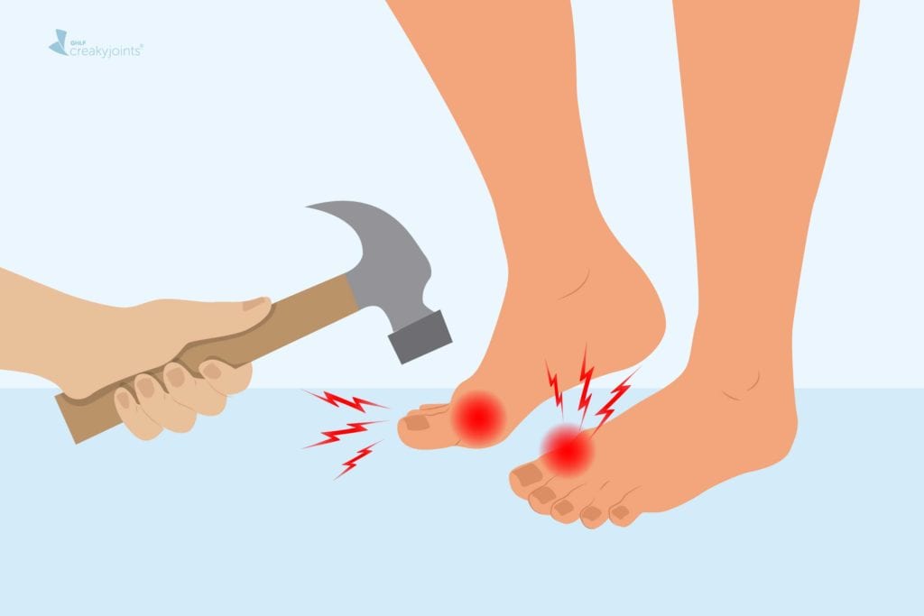 What Part of the Foot Does Gout Affect?