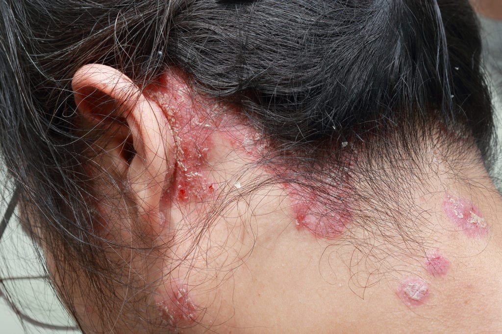 plaque psoriasis ear