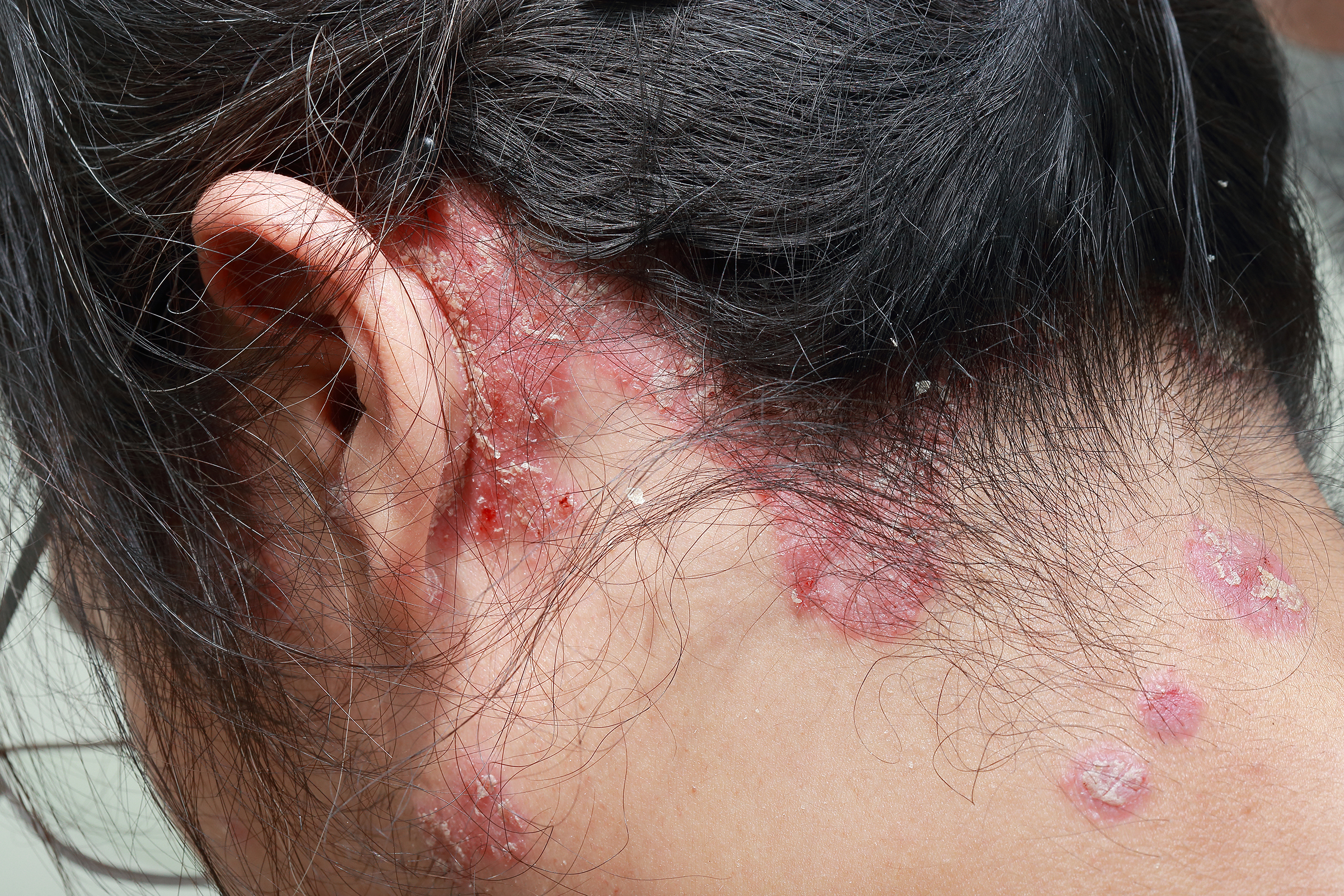 mujer con psoriasis del cuero cabelludo