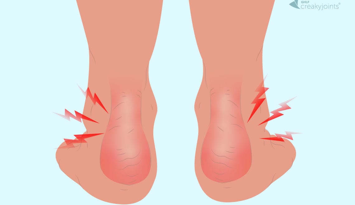 Swollen Painful Ankle Enthesitis Psoriatic Arthritis