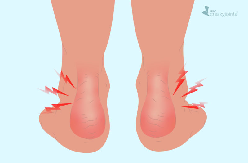 Swollen Painful Ankle Enthesitis Psoriatic Arthritis