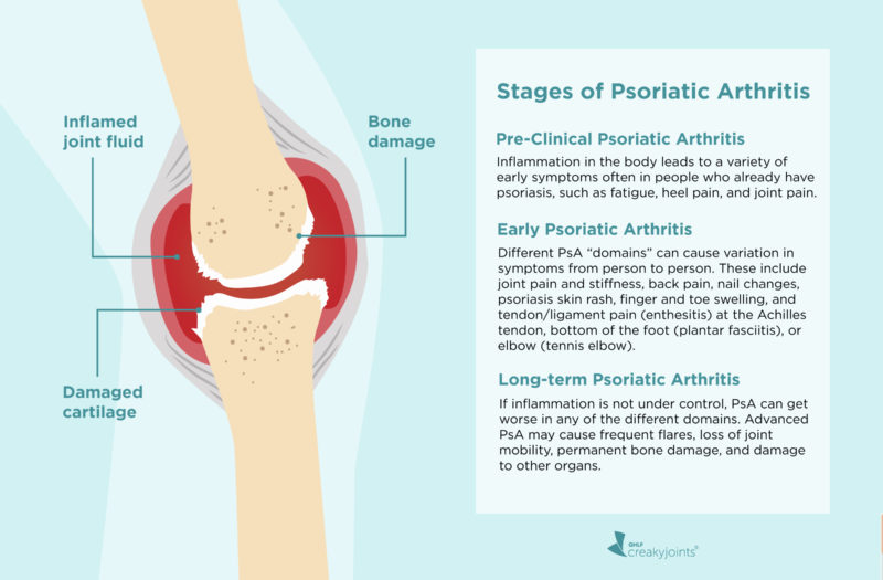 rheumatoid arthritis stages