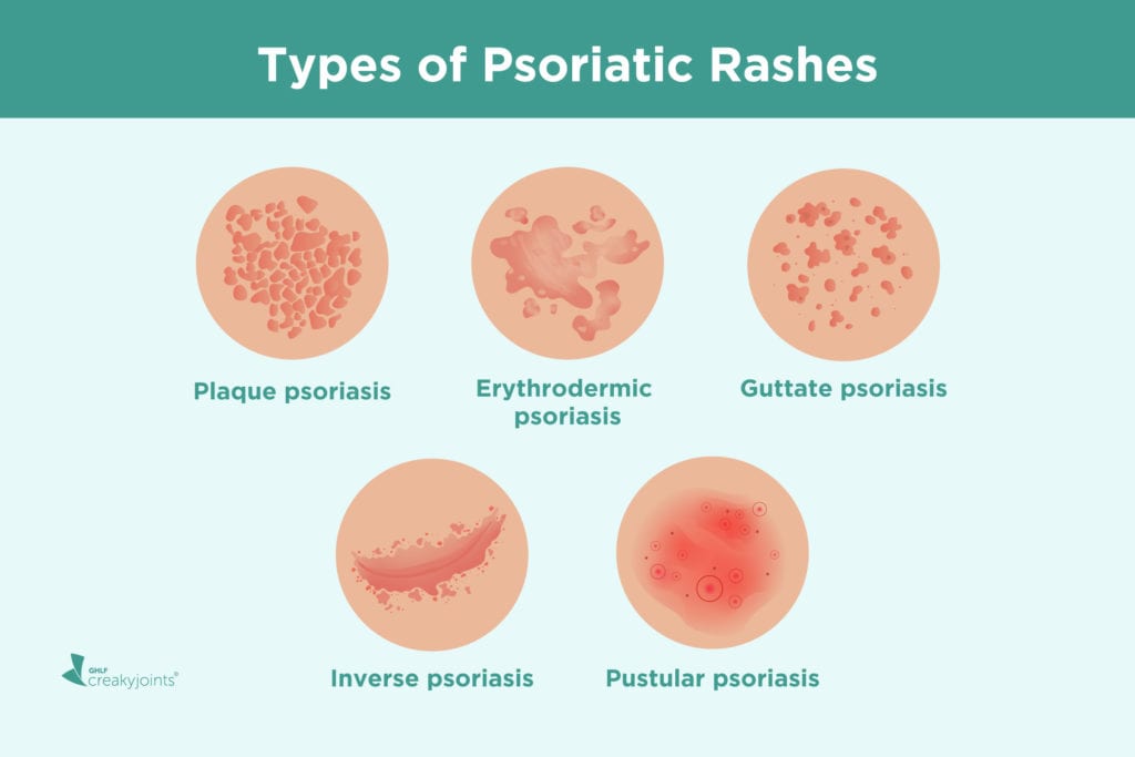 Inkompatibilis psoriasis