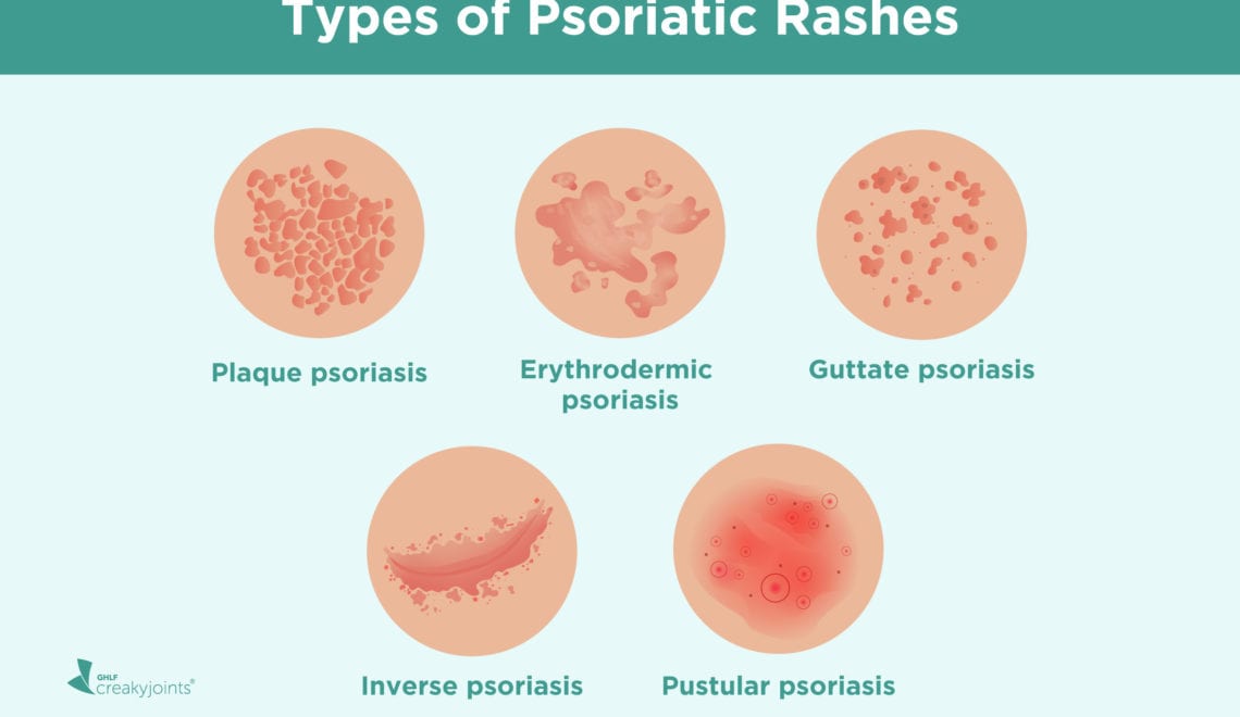 Psoriatic Arthritis Psoriasis Rashes