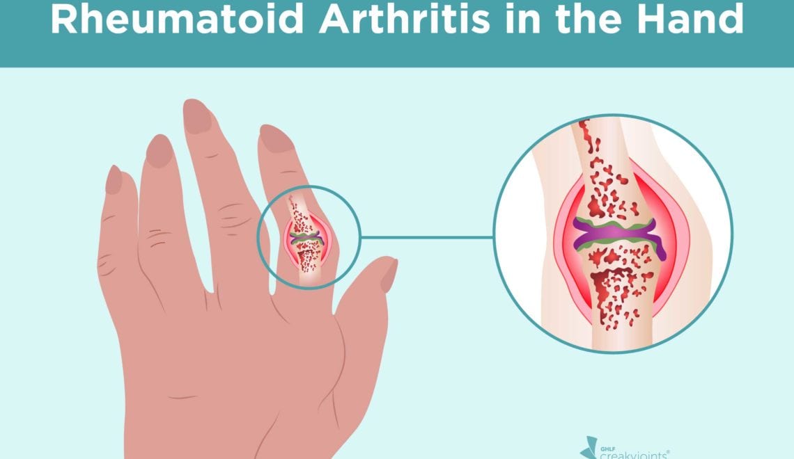 Rheumatoid Arthritis in the Hand