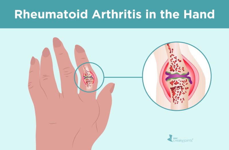 Rheumatoid Arthritis in the Hand