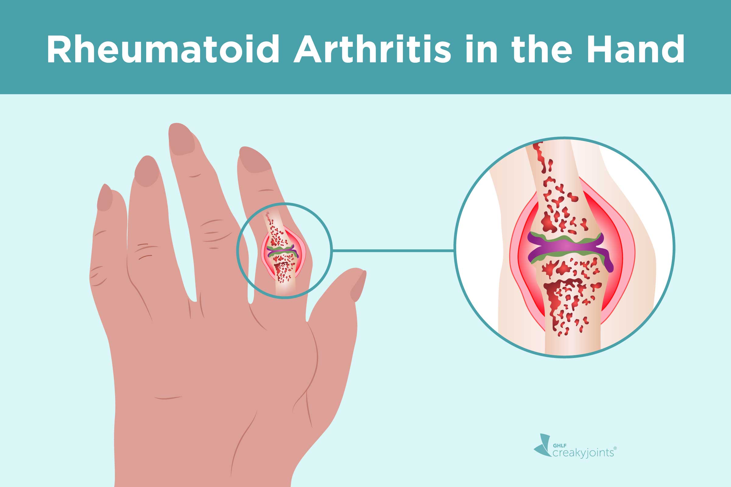 0920 Rheumatoid Arthritis Hand Logo 