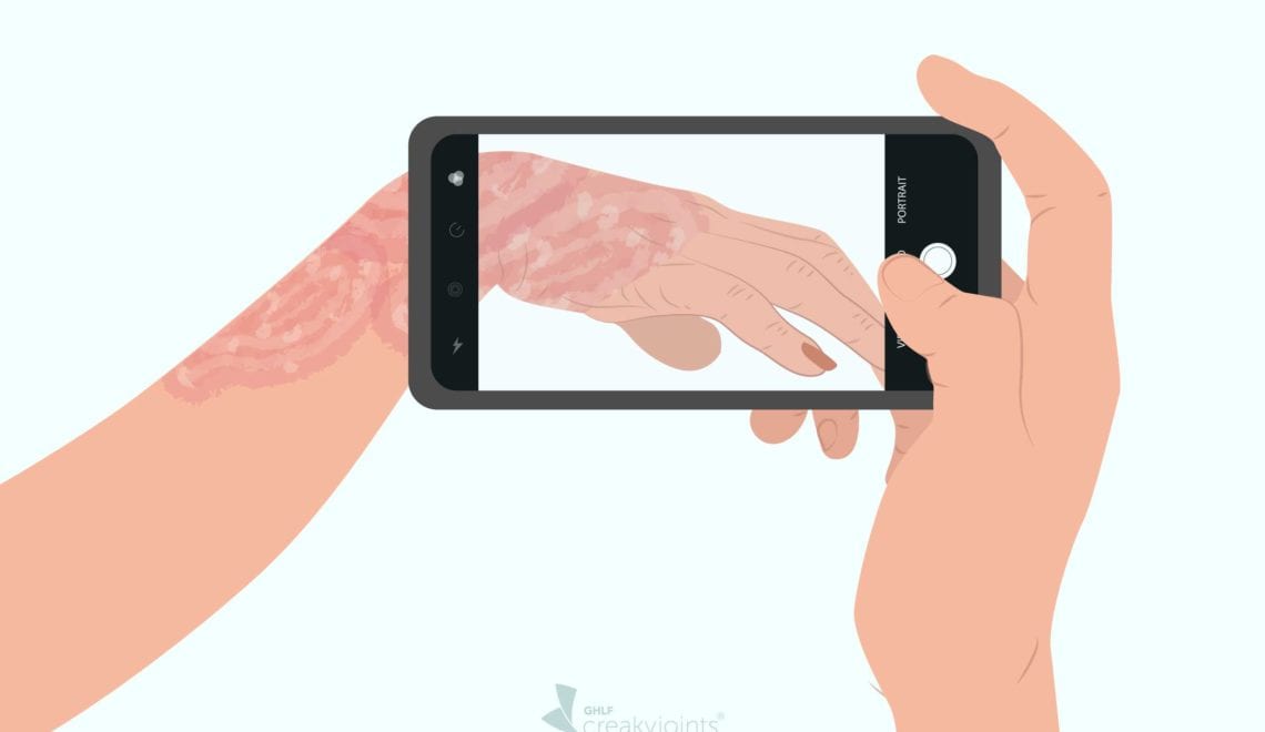 Taking Pictures of Psoriasis Psoriatic Arthritis for Telehealth Visit