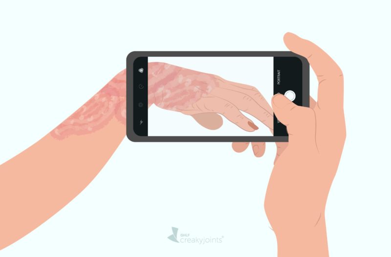 Taking Pictures of Psoriasis Psoriatic Arthritis for Telehealth Visit