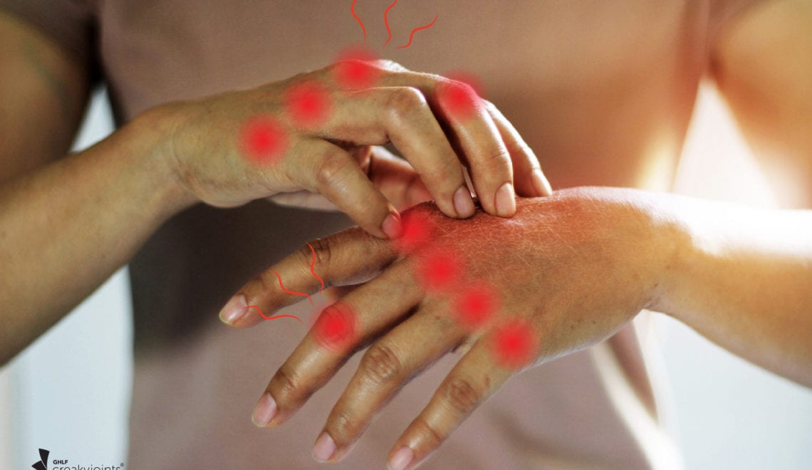 Arthritis Flare Disease Activity