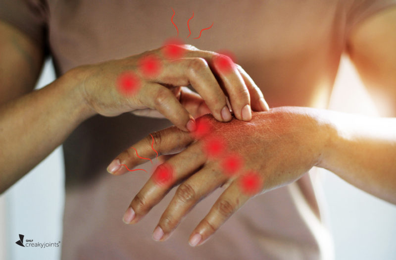 Arthritis Flare Disease Activity