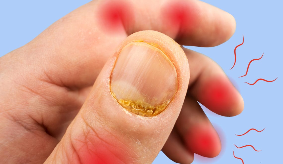 The hand of a patient who has psoriatic arthritis. There are signs of fingernail psoriasis and joint stiffness/pain.