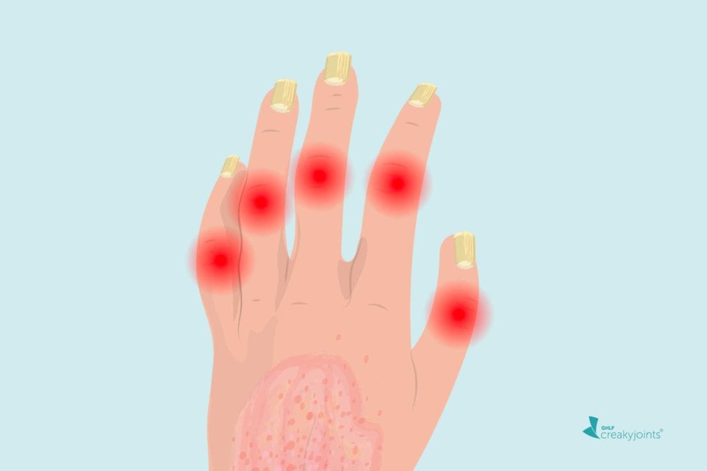 How to Care for Your Nails at Home with Psoriasis or Psoriatic Arthritis