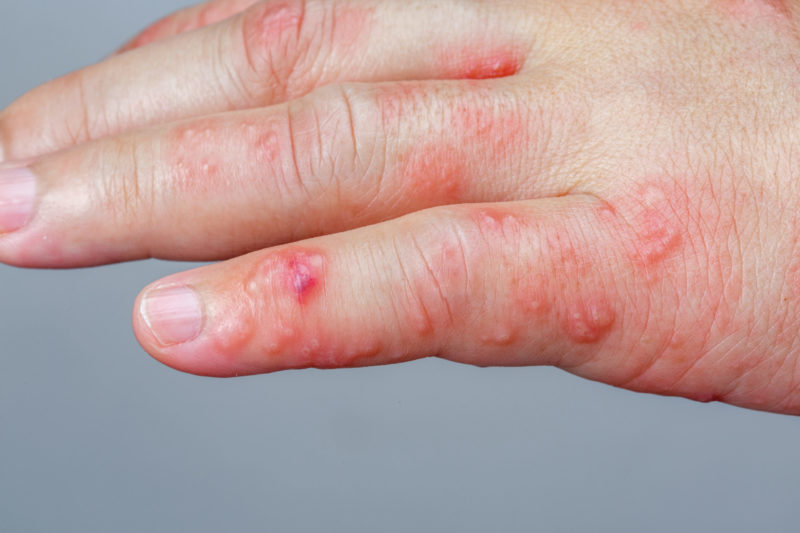 blisters-on-hands-treatment-pictures-causes-remedies