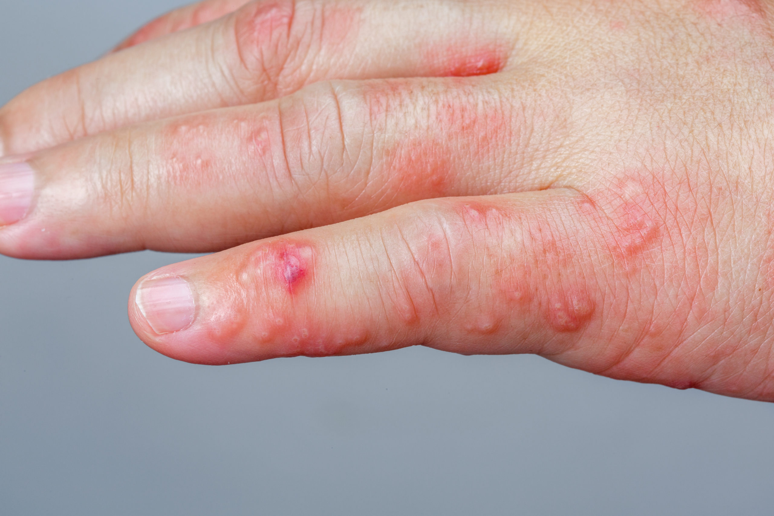 covid-toes-other-rashes-latest-possible-rare-virus-signs-whyy