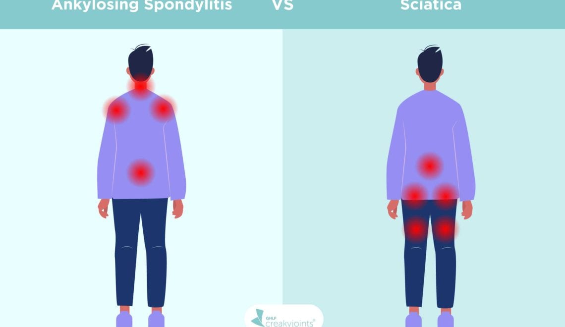 Illustration is a side-by-side of two people. The person to the left is showing signs of AS, as indicated by red pain spots in the lower back, neck, shoulders. Above that are the words “Ankylosing Spondylitis” The person on the right is showing signs of sciatica, indicated by red pain spots in the lower back, buttocks, and back of leg. Above that are the words “Sciatica” The word “vs.” is written between the two diseases.