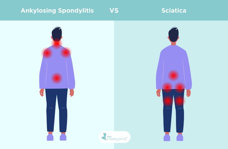 Illustration is a side-by-side of two people. The person to the left is showing signs of AS, as indicated by red pain spots in the lower back, neck, shoulders. Above that are the words “Ankylosing Spondylitis” The person on the right is showing signs of sciatica, indicated by red pain spots in the lower back, buttocks, and back of leg. Above that are the words “Sciatica” The word “vs.” is written between the two diseases.
