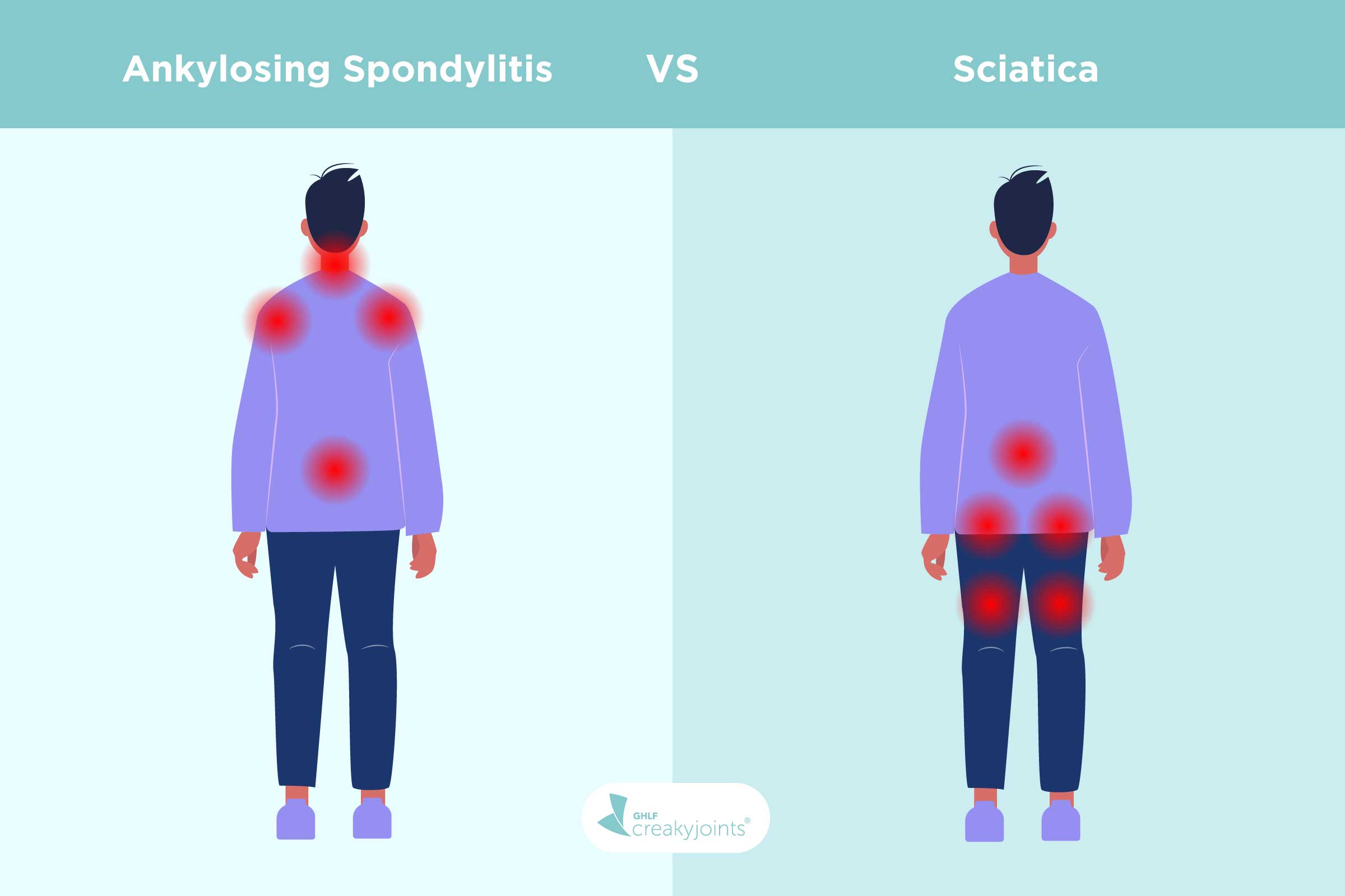 Arthritis vs. Sciatica: Differences in Risk Factors, Symptoms, Treatments