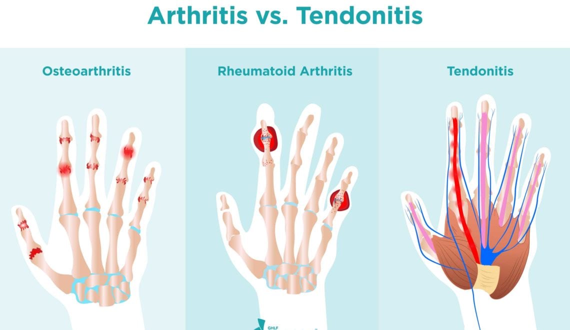 An illustration of three hands. On the left is a hand with red, inflamed joints. Above the hand is the word “Osteoarthritis.” In the middle is a hand with red, inflamed joints and red nodules. Above the hand is the word “Rheumatoid Arthritis.” On the right is a hand with red, inflamed tendons. Above the hand is the word “Tendonitis.”