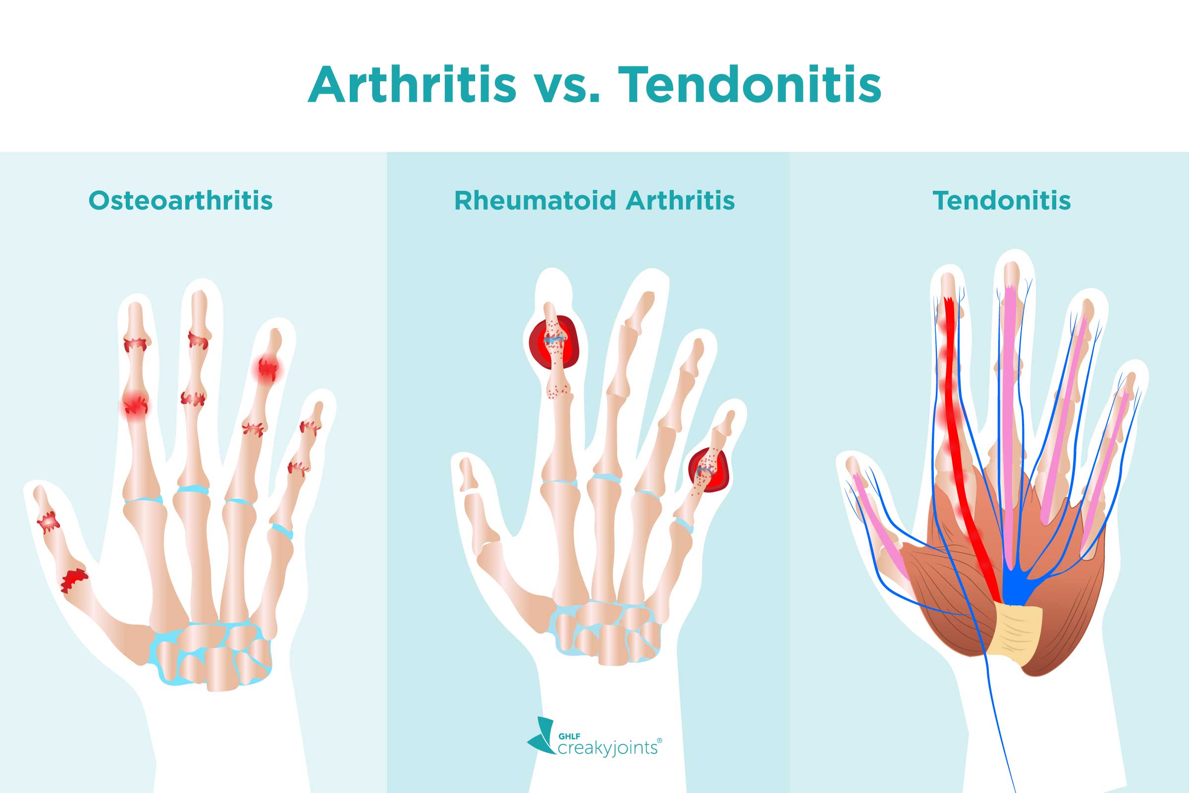 rheumatoid arthritis és osteoarthritis