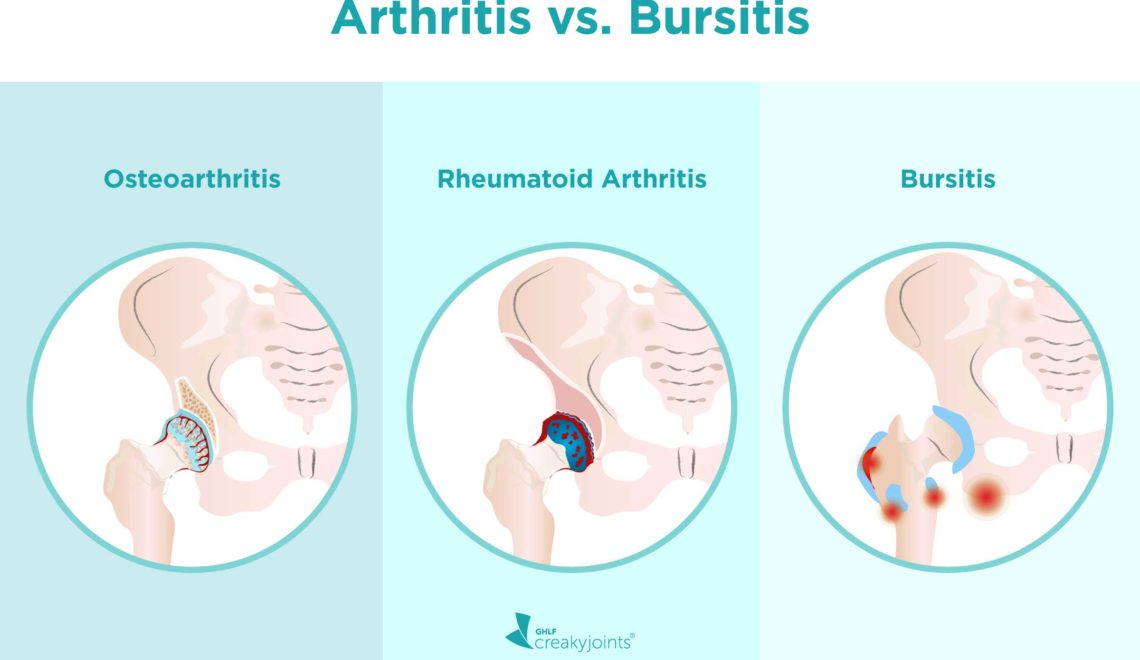 A side-by-side-by-side illustration of three hips. The top of the image reads “Arthritis vs. Bursitis” The hip on the left is affected by osteoarthritis. Above the hip is written “Osteoarthritis” The image shows narrow joint space between the socket and cartilage, worn down cartilage (which are illustrated with red cracks on the cartilage), and bone spurs (which are illustrated with small bulging circle on the bone beneath the cartilage). The hip in the middle is affected by rheumatoid arthritis. Above the hip ia written “Rheumatoid Arthritis” The image shows an inflamed, red joint, which is located in the area between the femoral head and socket. The hip on the right is affected by bursitis. Above the hip is written “Bursitis” The image shows an inflamed, red bursa, which is a sack located on the outside of the femur.