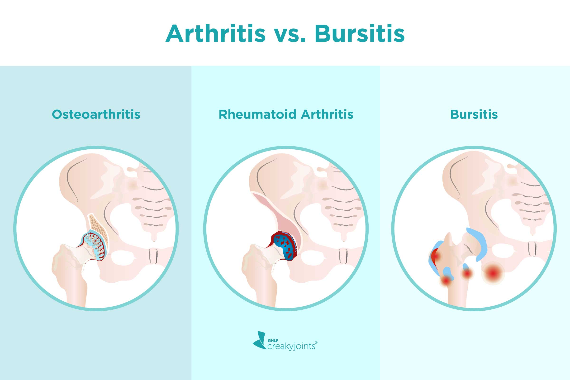 Bursitis (nyáktömlő-gyulladás) tünetei, okai, jelei, megelőzése, kezelése, gyógyítása