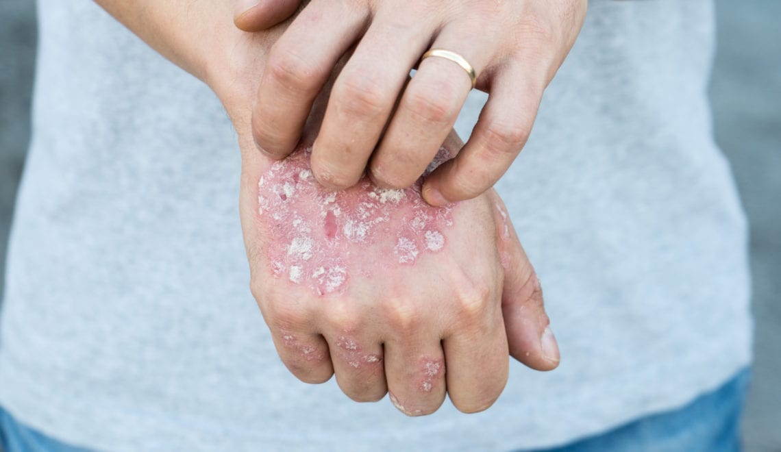 Man scratching oneself, dry flaky skin on hand with psoriasis vulgaris, eczema and other skin conditions like fungus, plaque, rash and patches.