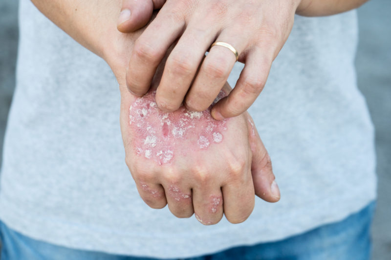 Man scratching oneself, dry flaky skin on hand with psoriasis vulgaris, eczema and other skin conditions like fungus, plaque, rash and patches.