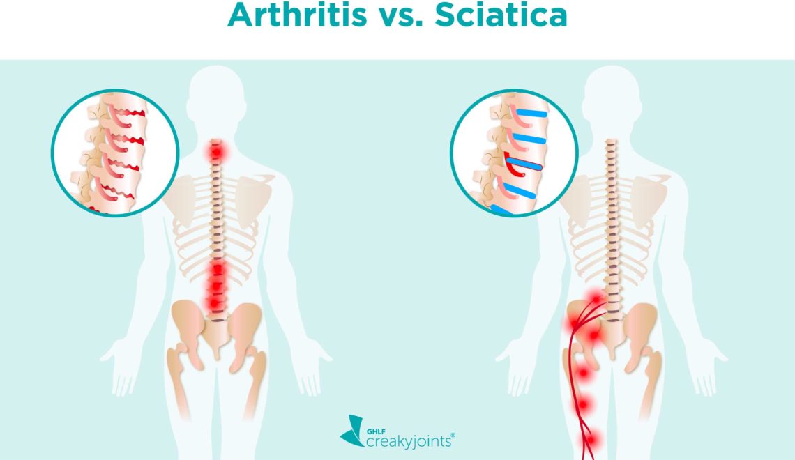 A side-by-side of two spines. On the top, the words “Arthritis vs. Sciatica.” The back/spine on the left is affected by arthritis. The image shows worn down cartilage (which is illustrated with red cracks on the cartilage), and inflammation to the spinal nerves and discs (which is illustrated with red pain spots). The back/spine on the right is affected by sciatica. The image shows inflammation where the sciatica nerve meets the piriformis muscle, and radiate down the rest of the nerve. There is also a herniated disc (a disc that is pushed further in than others).