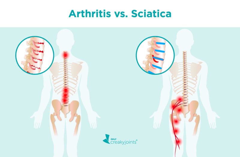 Arthritis vs. Sciatica: Differences in Risk Factors, Symptoms