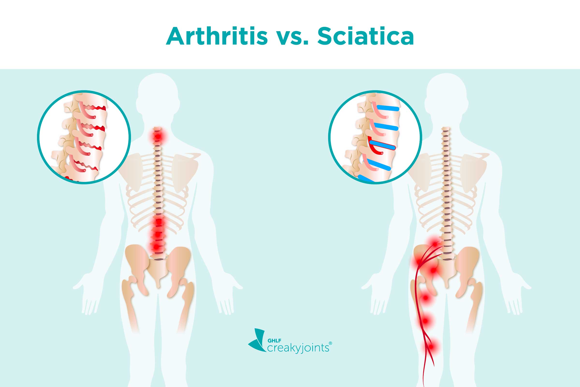 Arthritis vs. Sciatica: Differences in Risk Factors, Symptoms, Treatments