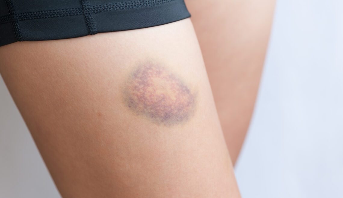 A person with a bruise on their upper thigh.