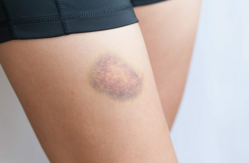 A person with a bruise on their upper thigh.