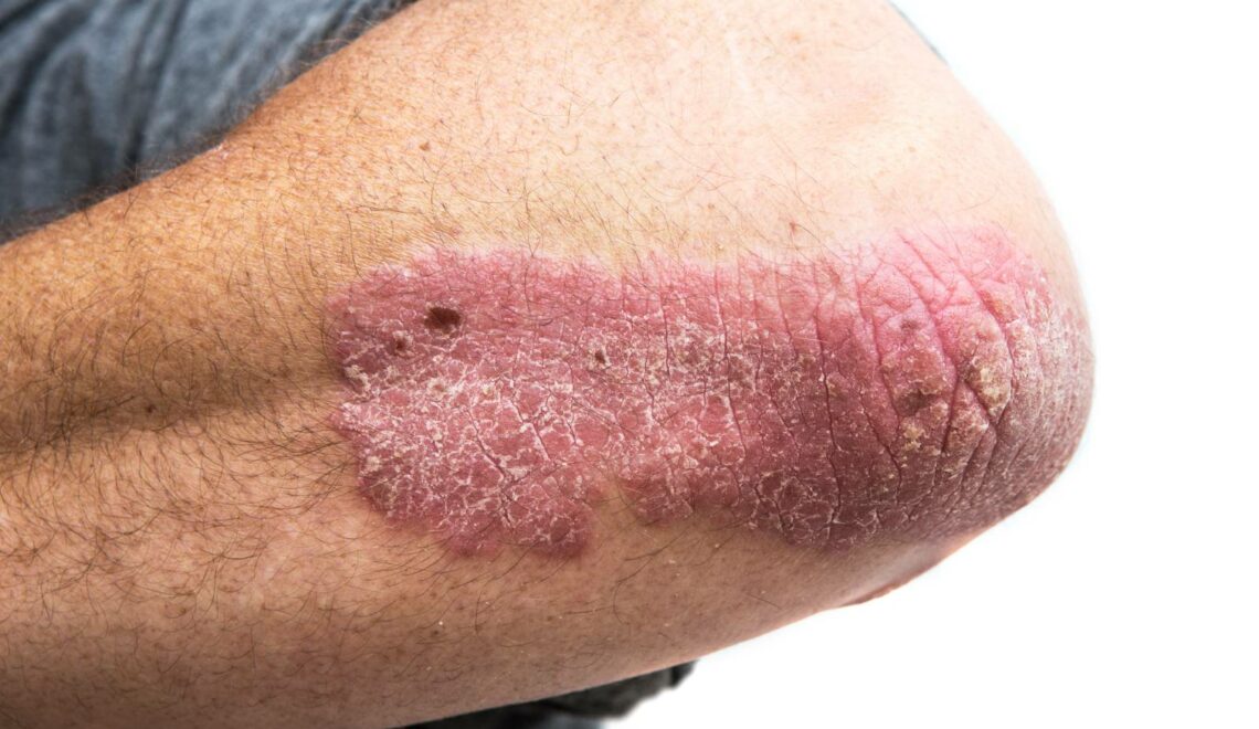 Psoriasis patch on a man's elbow.