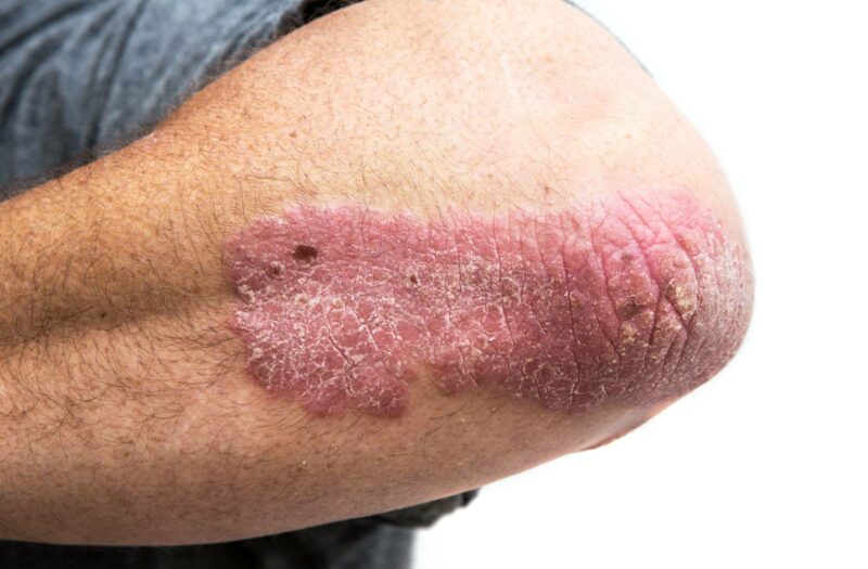 Psoriasis patch on a man's elbow.
