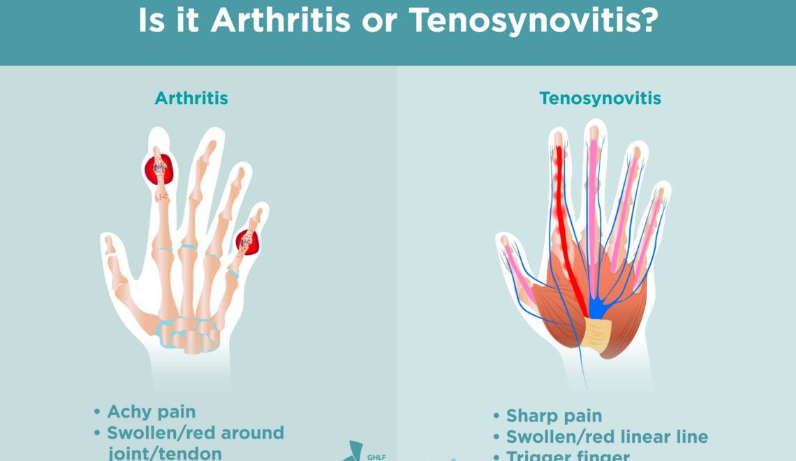 Is it Arthritis or Tenosynovitis?