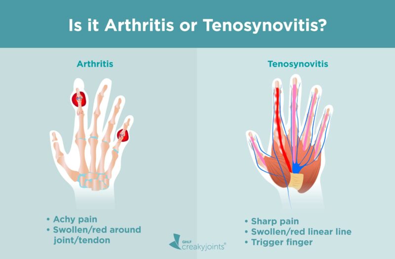 Is it Arthritis or Tenosynovitis?