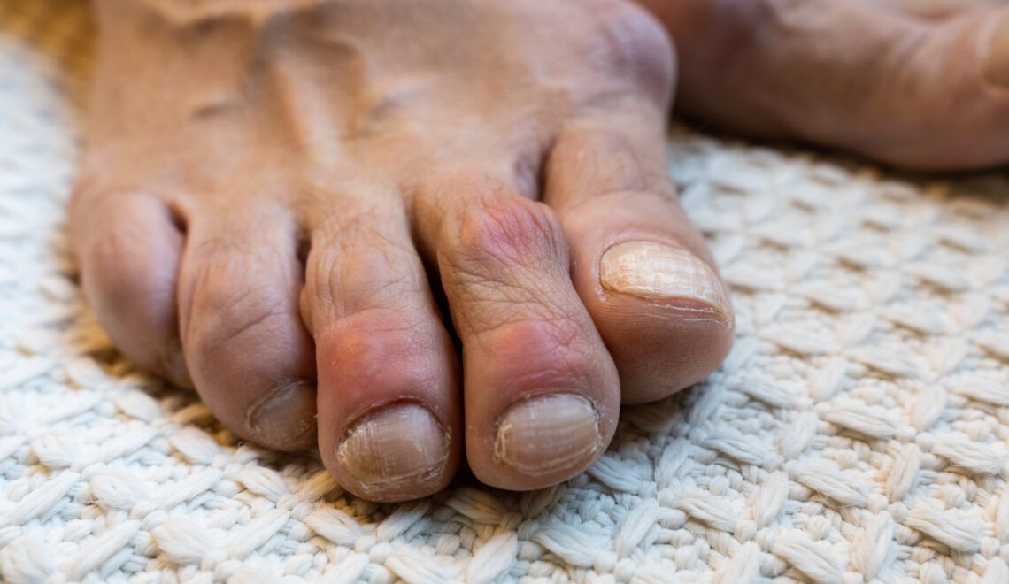 Photo that is a close-up of toes affected by gout. The toes appear red and inflamed because of a gout flare.