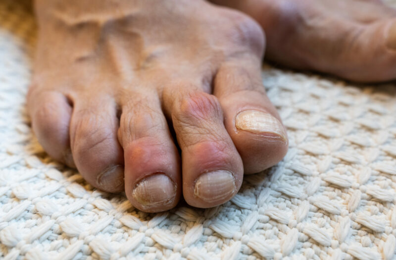 Photo that is a close-up of toes affected by gout. The toes appear red and inflamed because of a gout flare.
