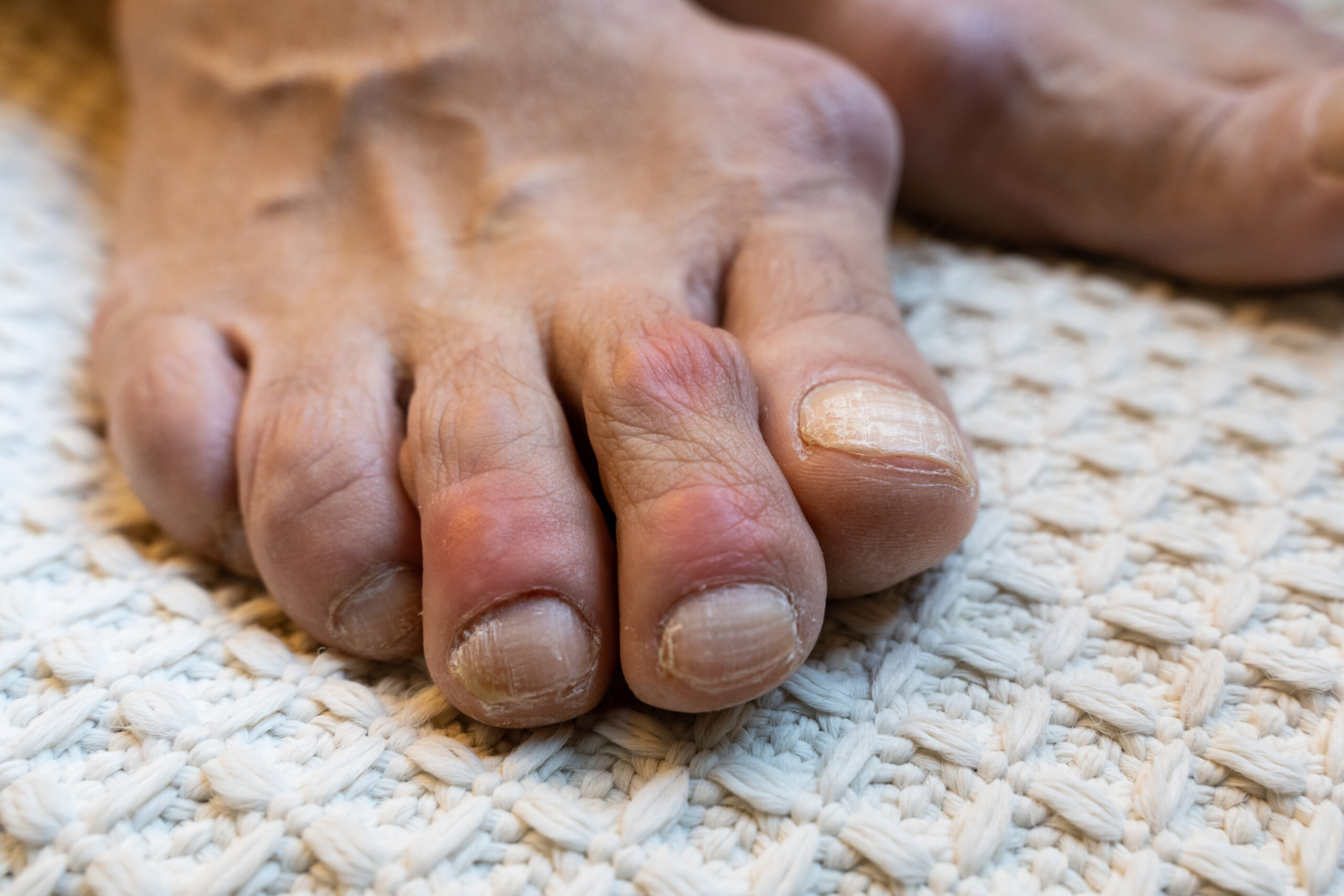 What Part of the Foot Does Gout Affect?