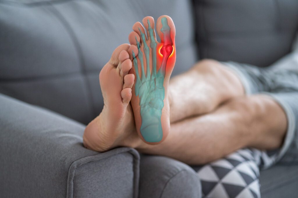 Photograph of a person's legs lying on a coach with the bottom of a foot inflamed from a gout flare