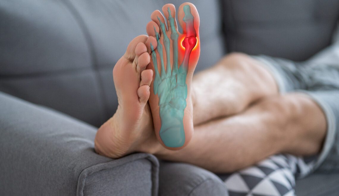 Photograph of a person's legs lying on a coach with the bottom of a foot inflamed from a gout flare