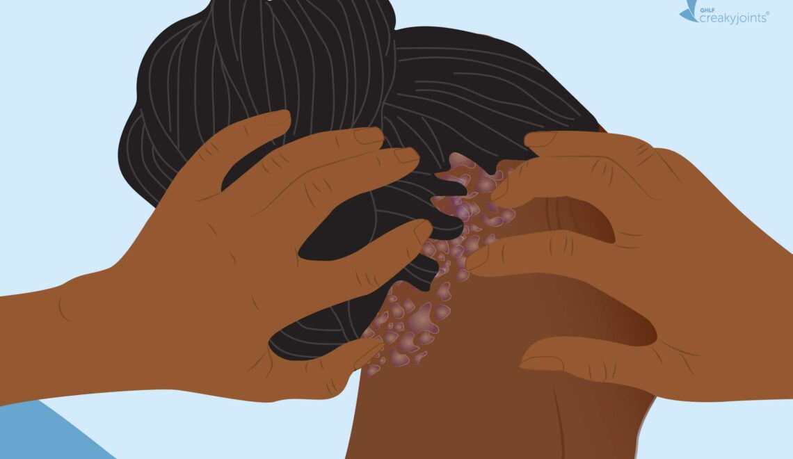 illustration of scalp psoriasis on Black hair