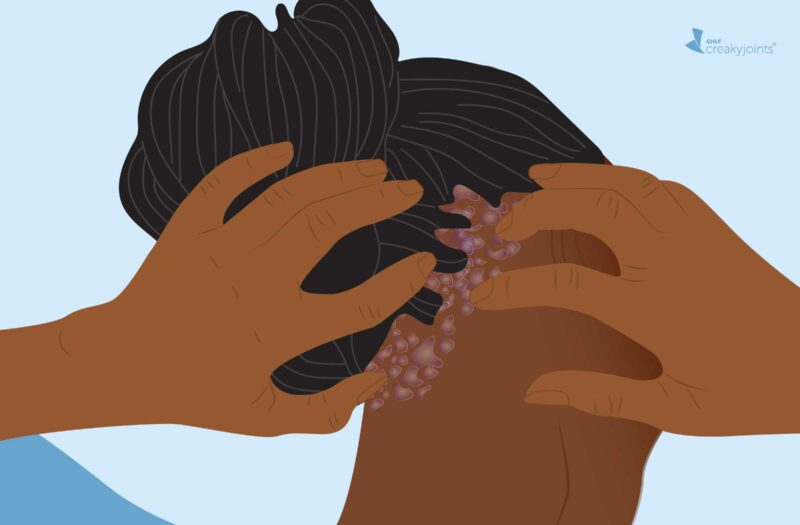 Navigating Black Hair and Scalp Psoriasis