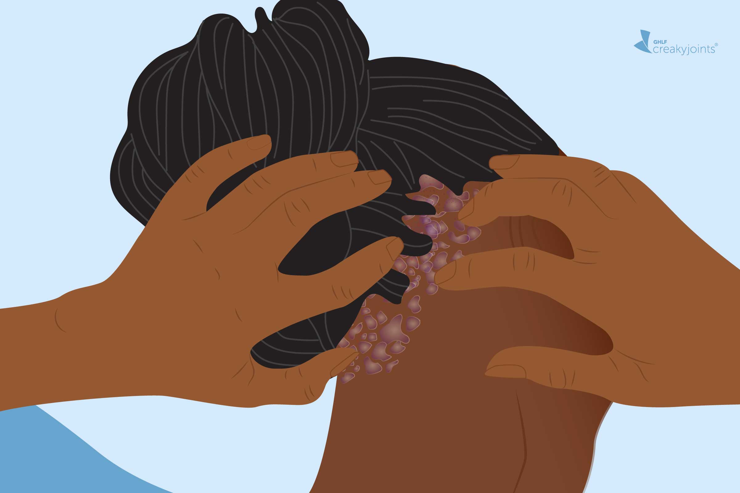 illustration of scalp psoriasis on Black hair