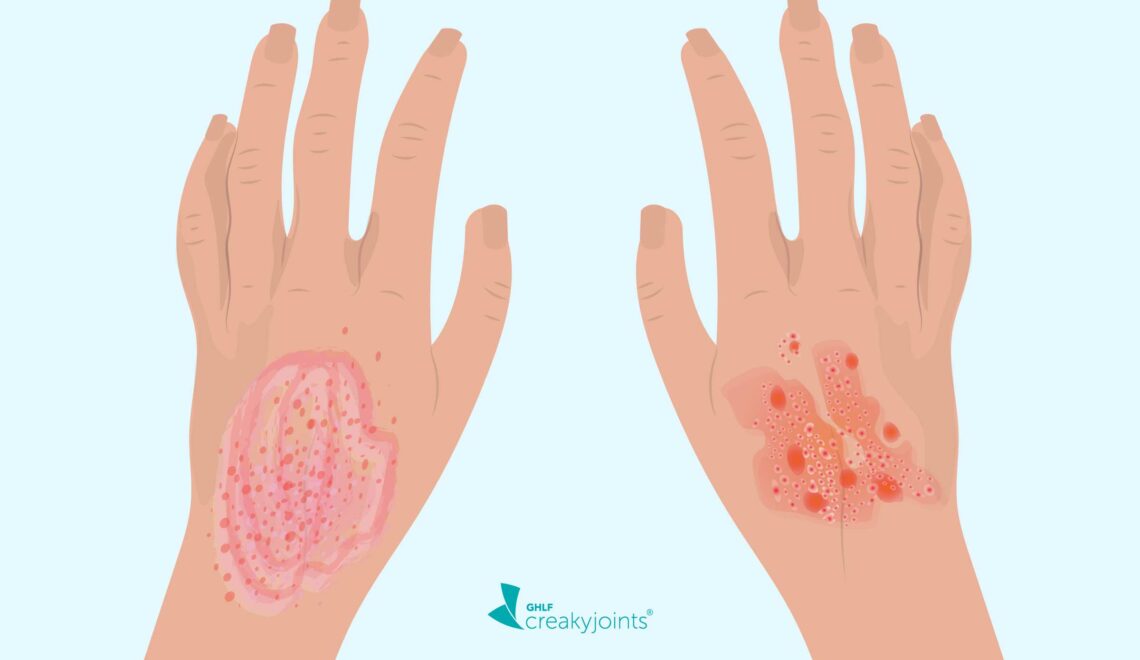 Image of hand with eczema and hand with psoriasis